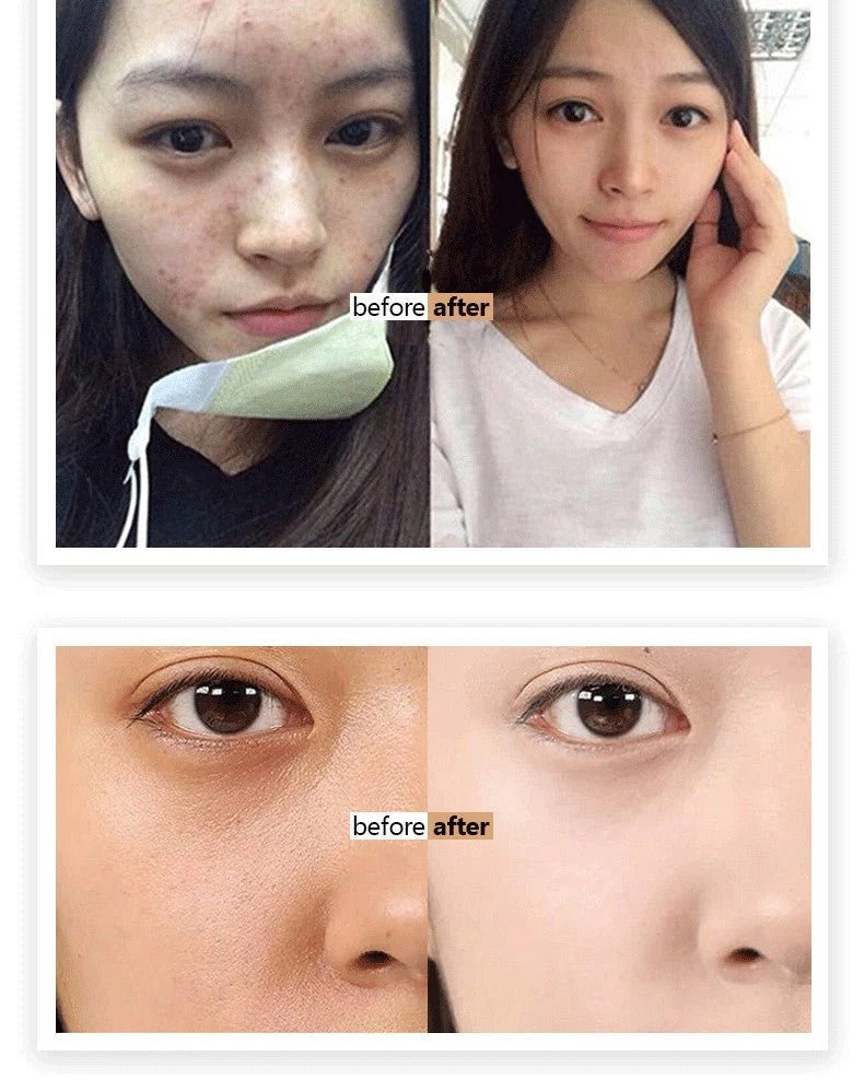 Dr. Sugarm Acne Treatment Cream
